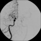 Occlusion of middle cerebral artery, MCA, collateral flow, postischemic changes: AG - Angiography